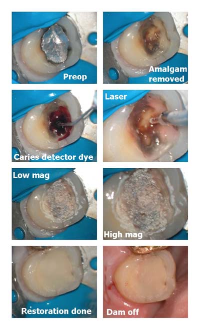 Erbium disinfection.jpg